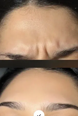 Avant/Après — injections-botox
